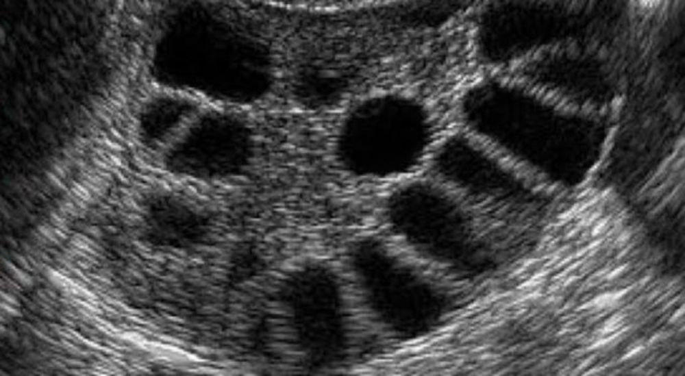 IVF success rates are very high in PCO patients in Azoury IVF lebanon clinic