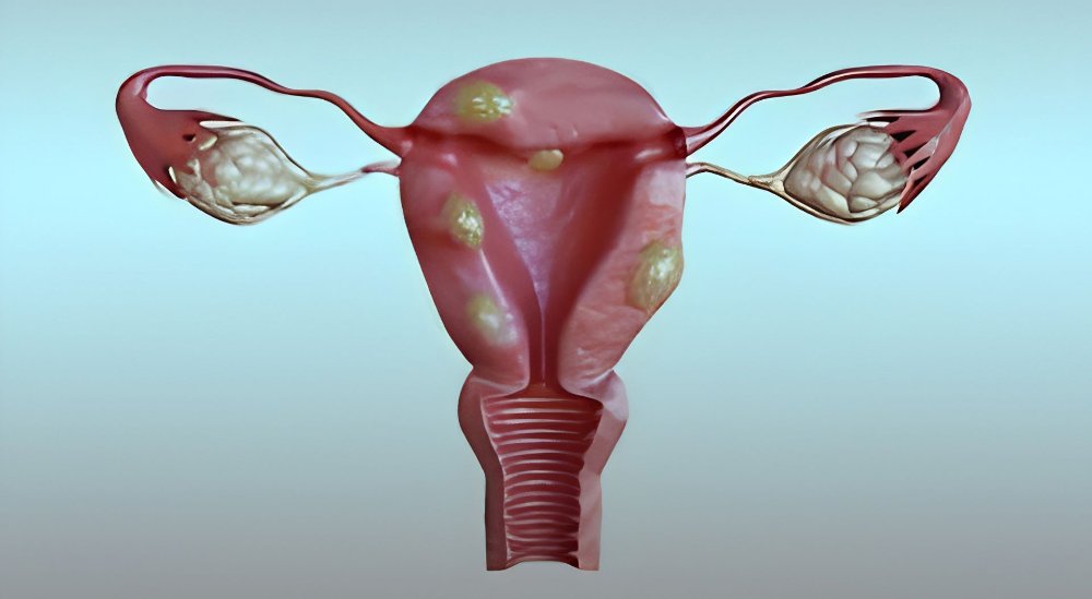 Medical illustration of uterine fibroids and their location within the uterus Medical illustration of uterine fibroids and their location within the uterus