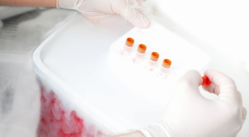 Sperm freezing in Azoury IVF lebanon clinic allows fertility preservation in men